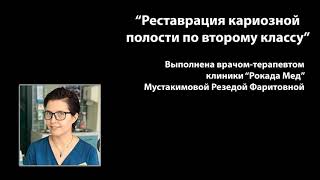 "Реставрация кариозной полости по второму классу" работа выполнена врачом-терапевтом клиники "Рокада Мед" Резедой Фаритовной Мустакимовой